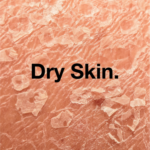 Dry & Dehydrated Skin