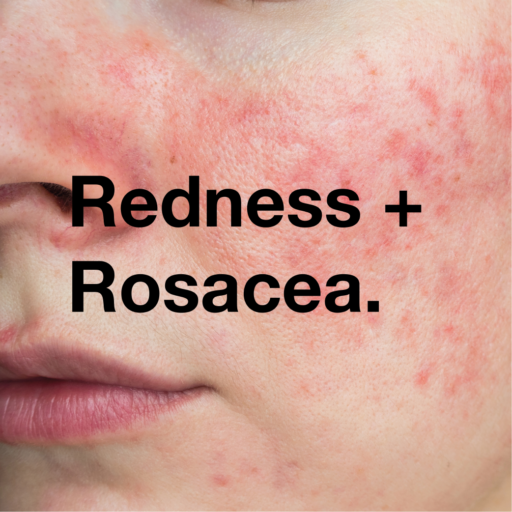 Redness & Rosacea