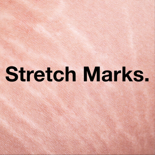 Stretch Marks