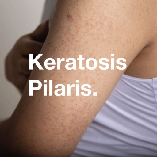 Keratosis Pilaris